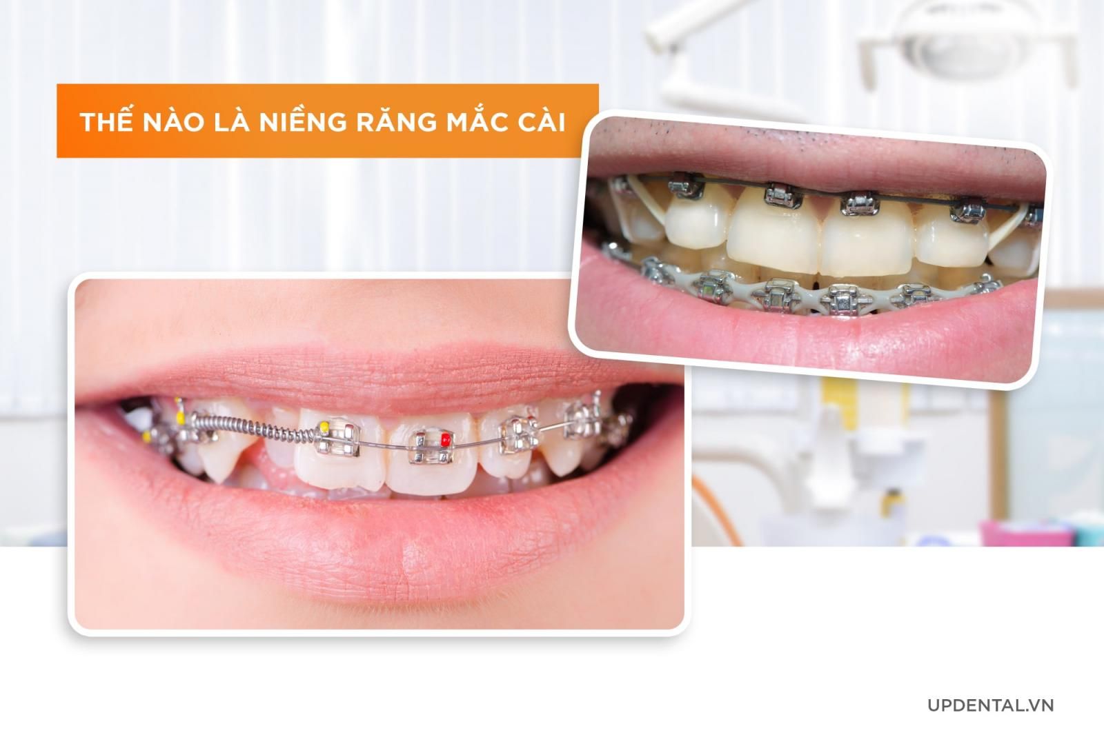 gắn mắc cài vị trí nào