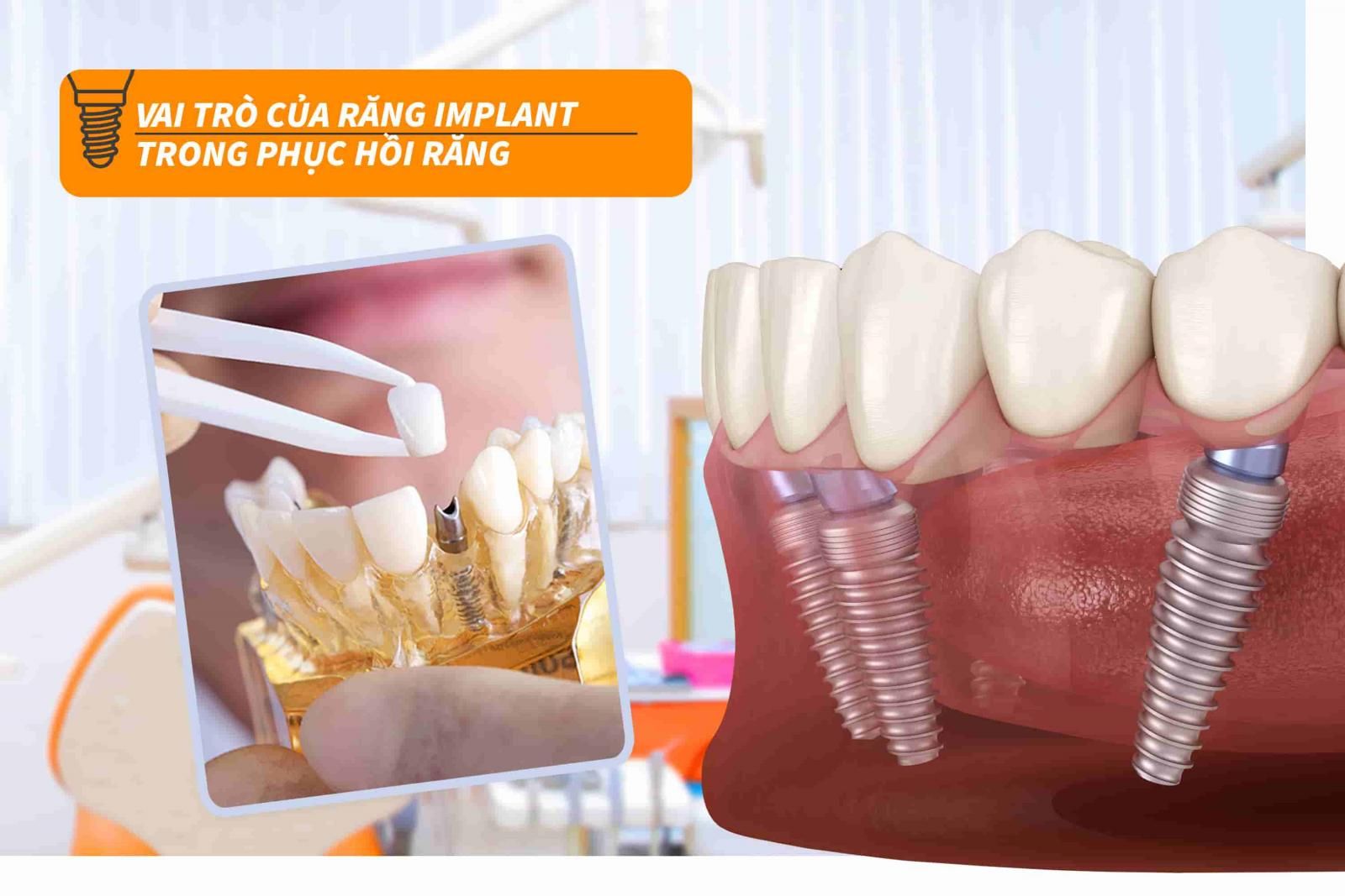 Vai trò của răng Implant trong phục hồi răng