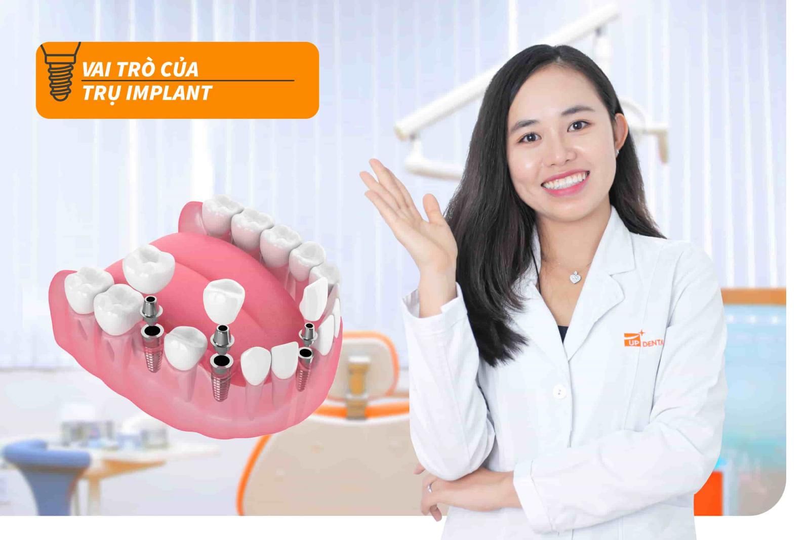 Vai trò của trụ Implant