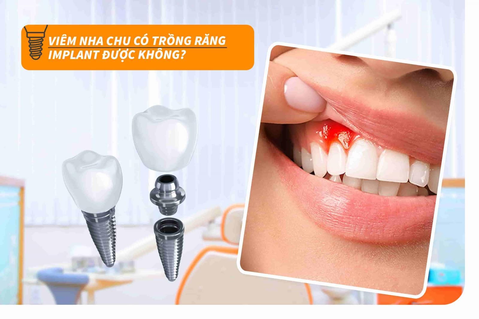 Viêm nha chu có trồng răng Implant được không?