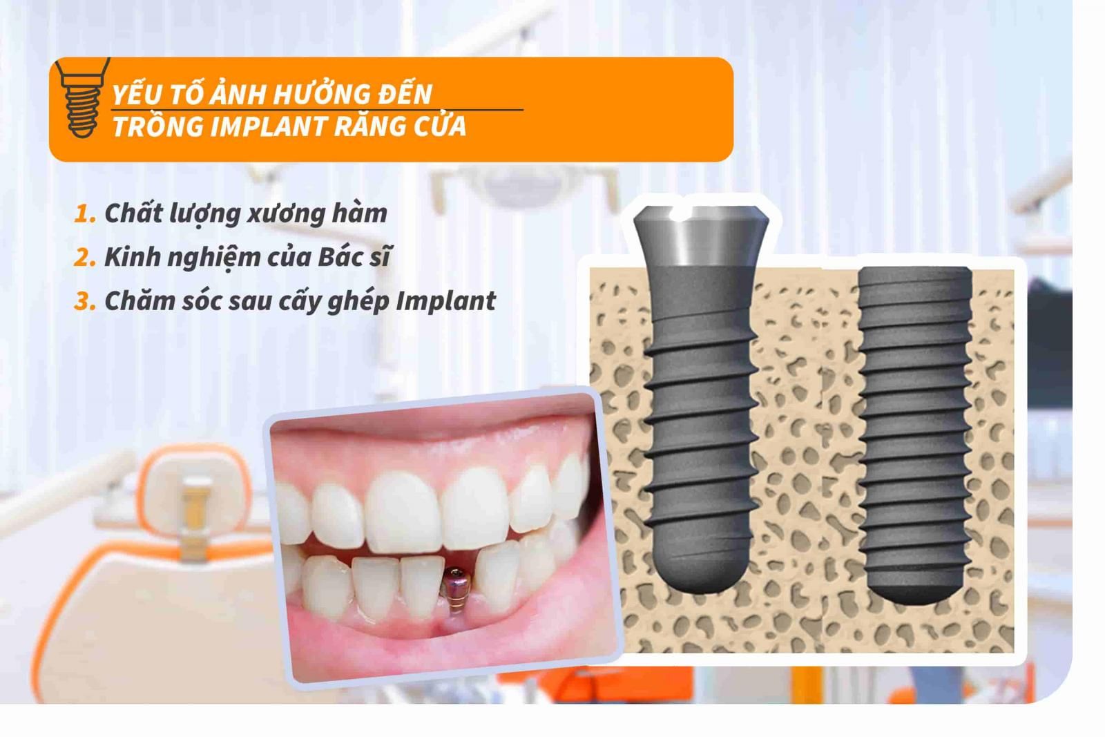 Yếu tố ảnh hưởng đến trồng Implant răng cửa