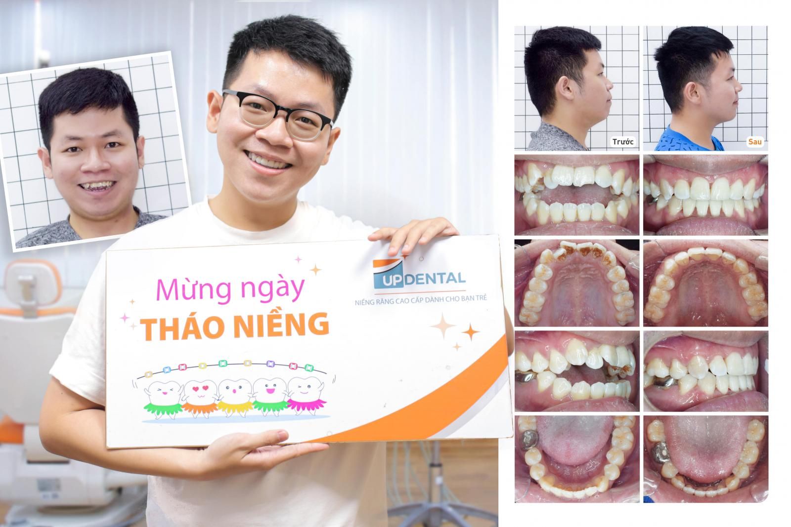 khuôn mặt trước và sau niềng răng khớp cắn hở