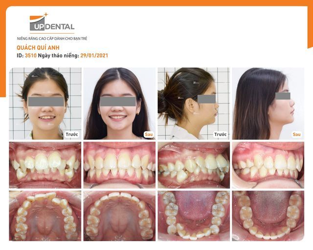 ảnh niềng răng thay đổi khuôn mặt tại up dental