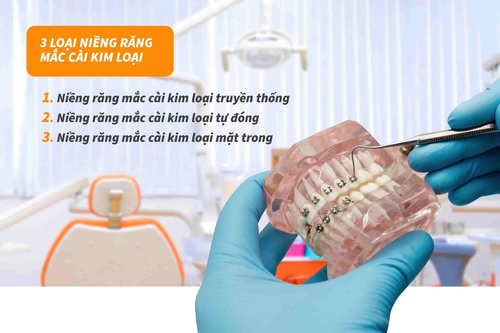 Niềng răng mắc cài kim loại 