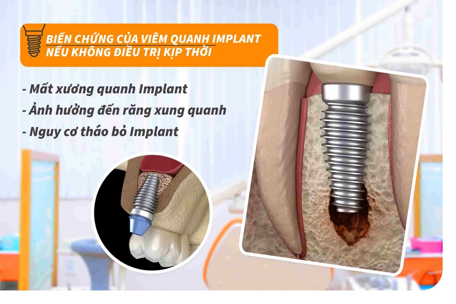 Biến chứng của viêm quanh Implant nếu không điều trị kịp thời