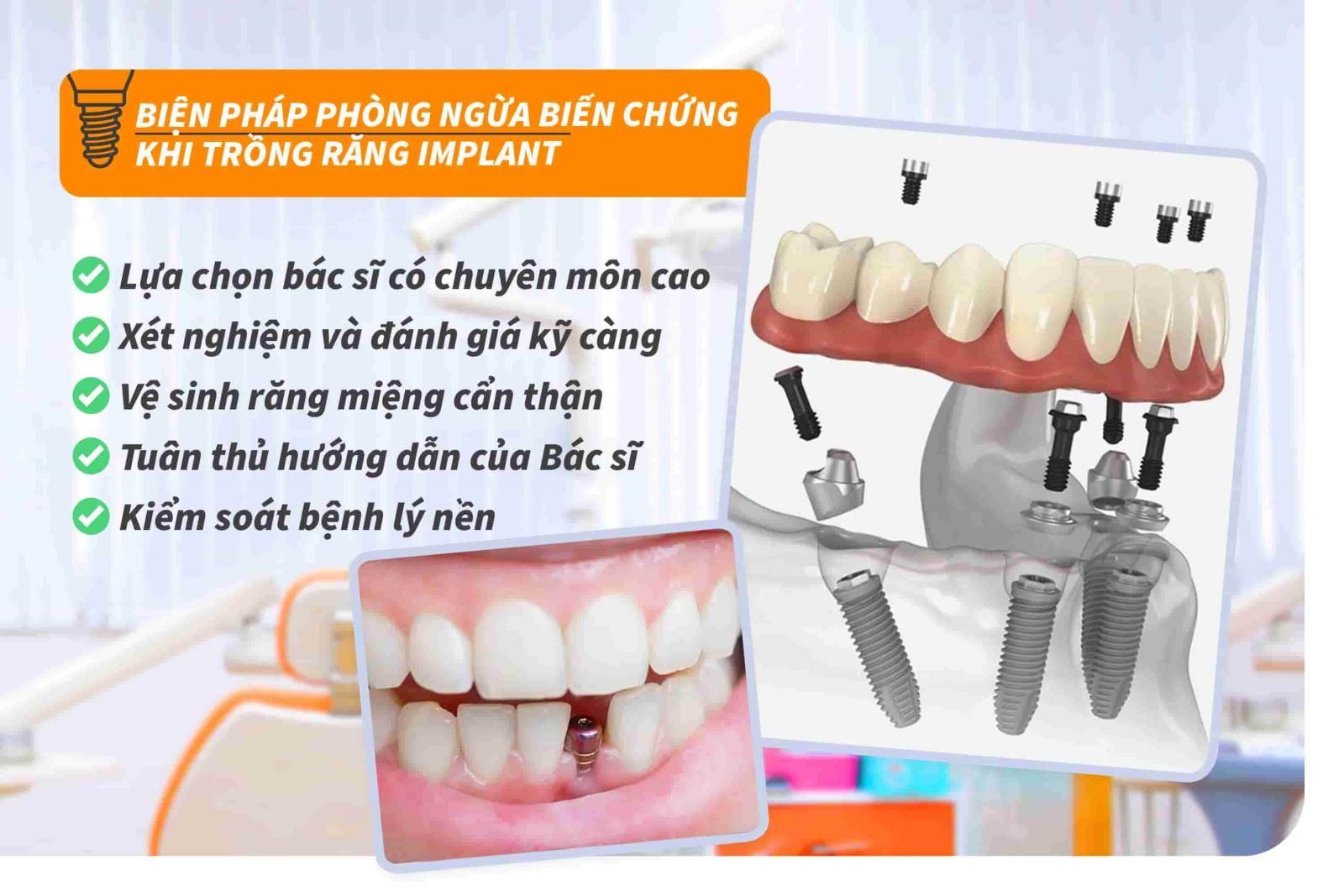 Biện pháp phòng ngừa biến chứng khi trồng răng Implant