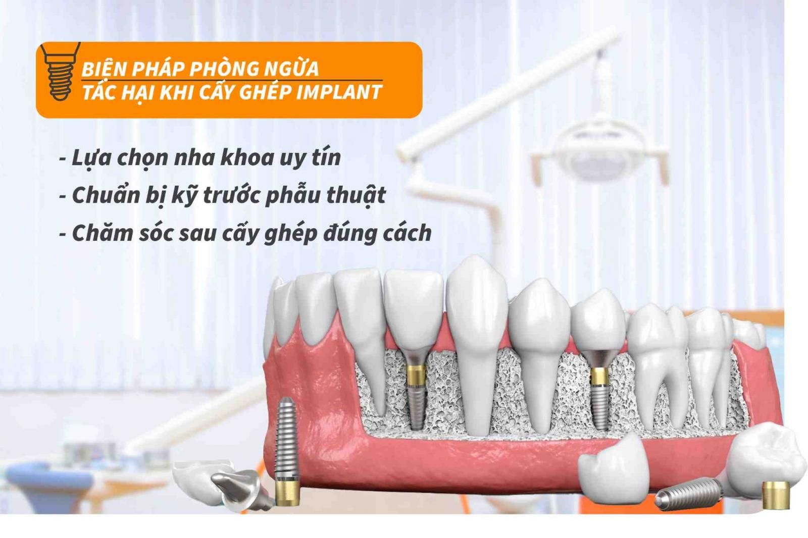 3 lưu ý để phòng ngừa tác hại khi cấy ghép Implant