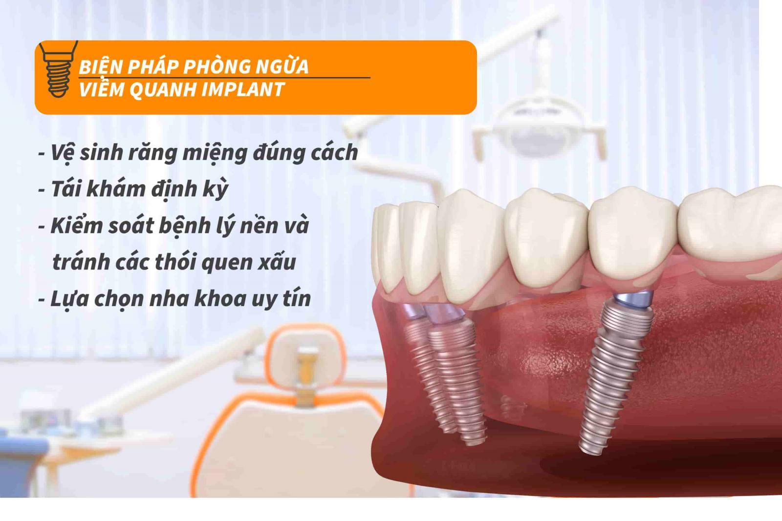 Biện pháp phòng ngừa viêm quanh Implant