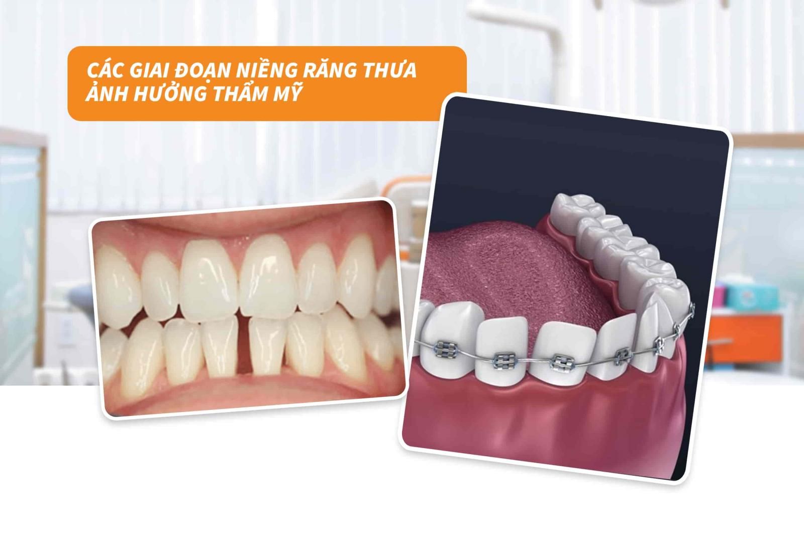 Các giai đoạn niềng răng thưa ảnh hưởng thẩm mỹ