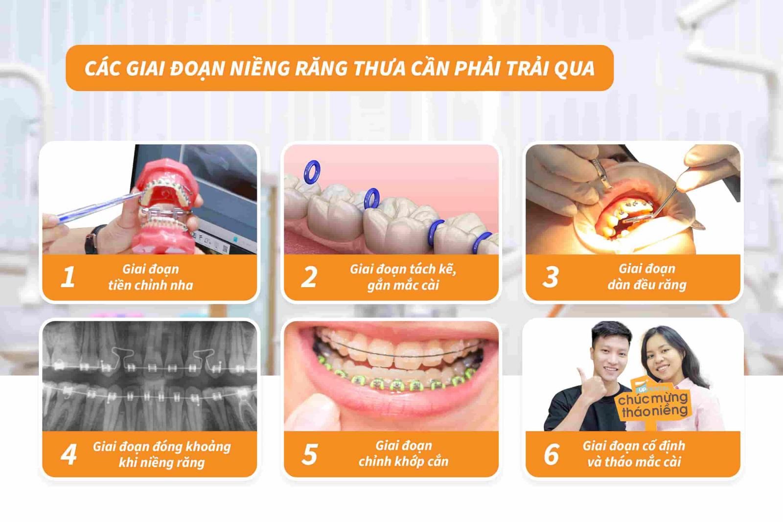 Các giai đoạn niềng răng thưa cần phải trải qua