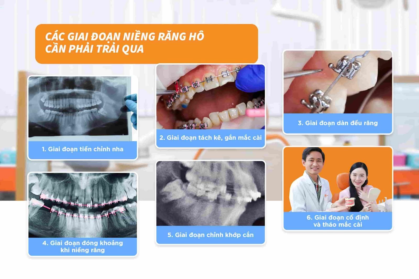 Các giai đoạn niềng răng hô cần phải trải qua