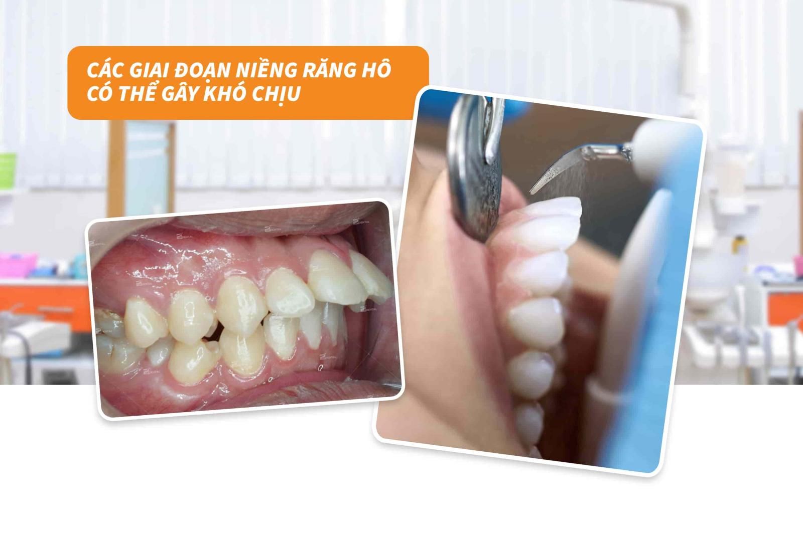 Các giai đoạn niềng răng hô có thể gây khó chịu