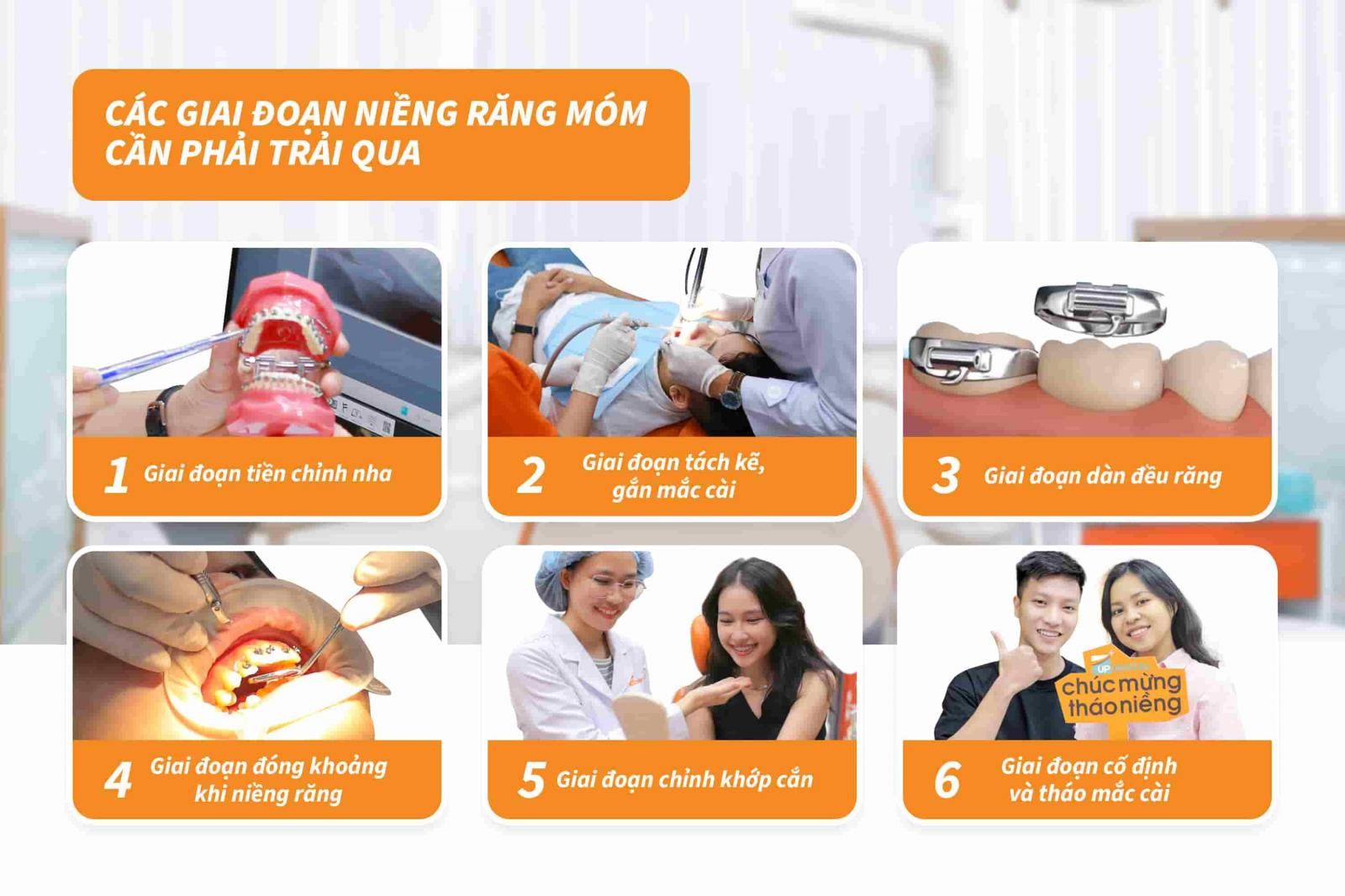 Các giai đoạn niềng răng móm cần phải trải qua