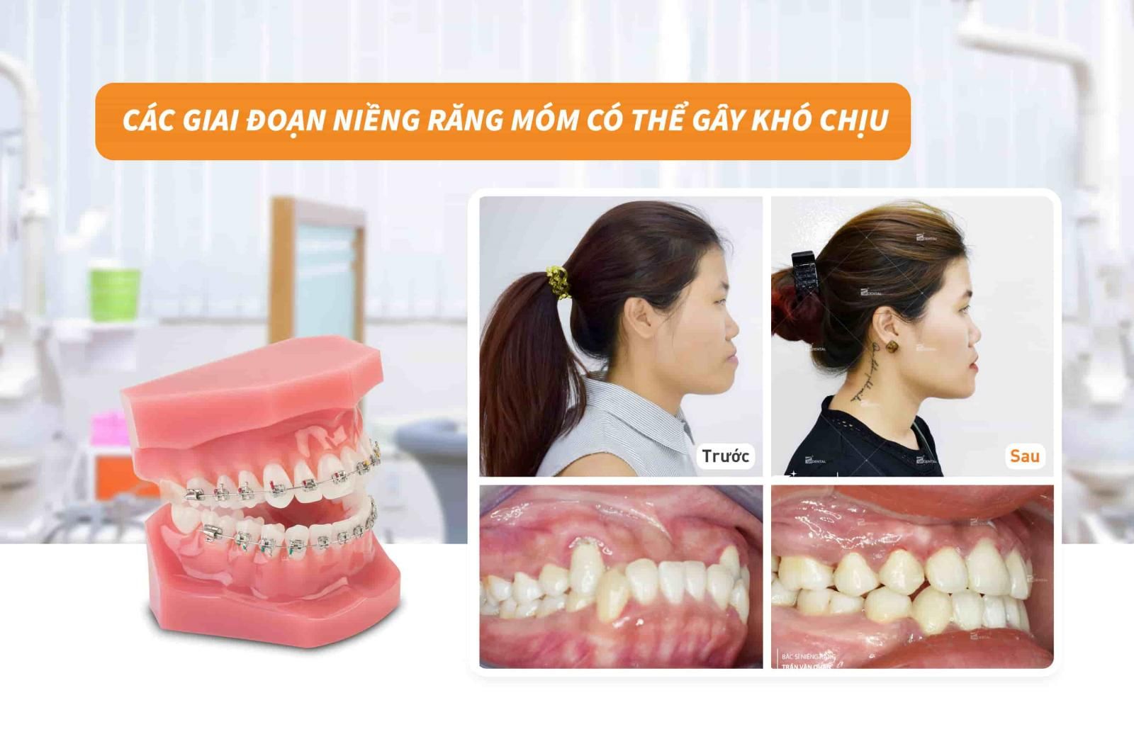 Các giai đoạn niềng răng móm có thể gây khó chịu 