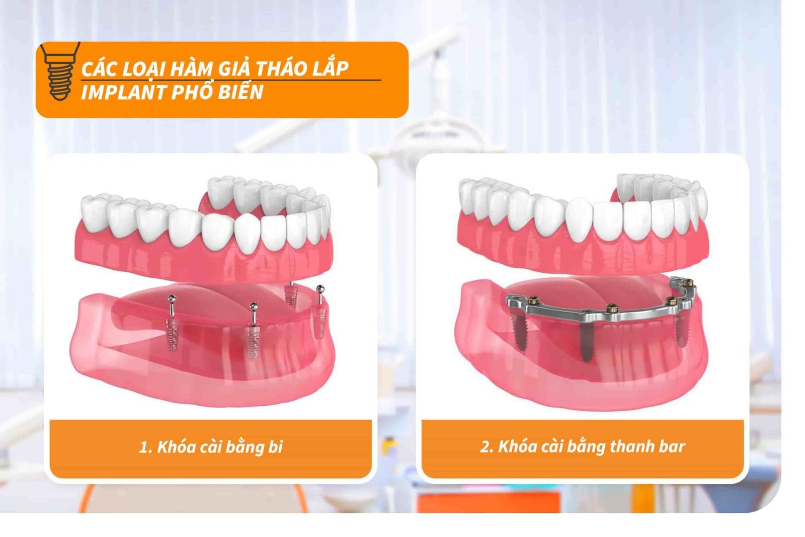 Các loại hàm giả tháo lắp Implant phổ biến