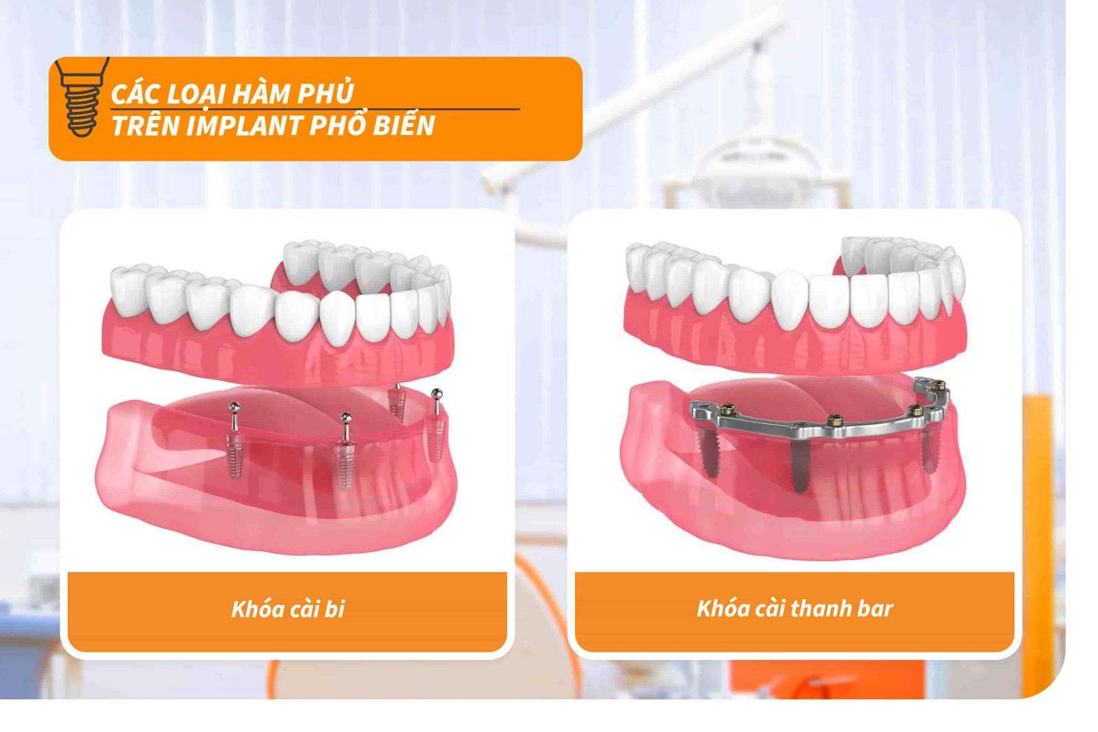 Các loại hàm phủ trên Implant phổ biến