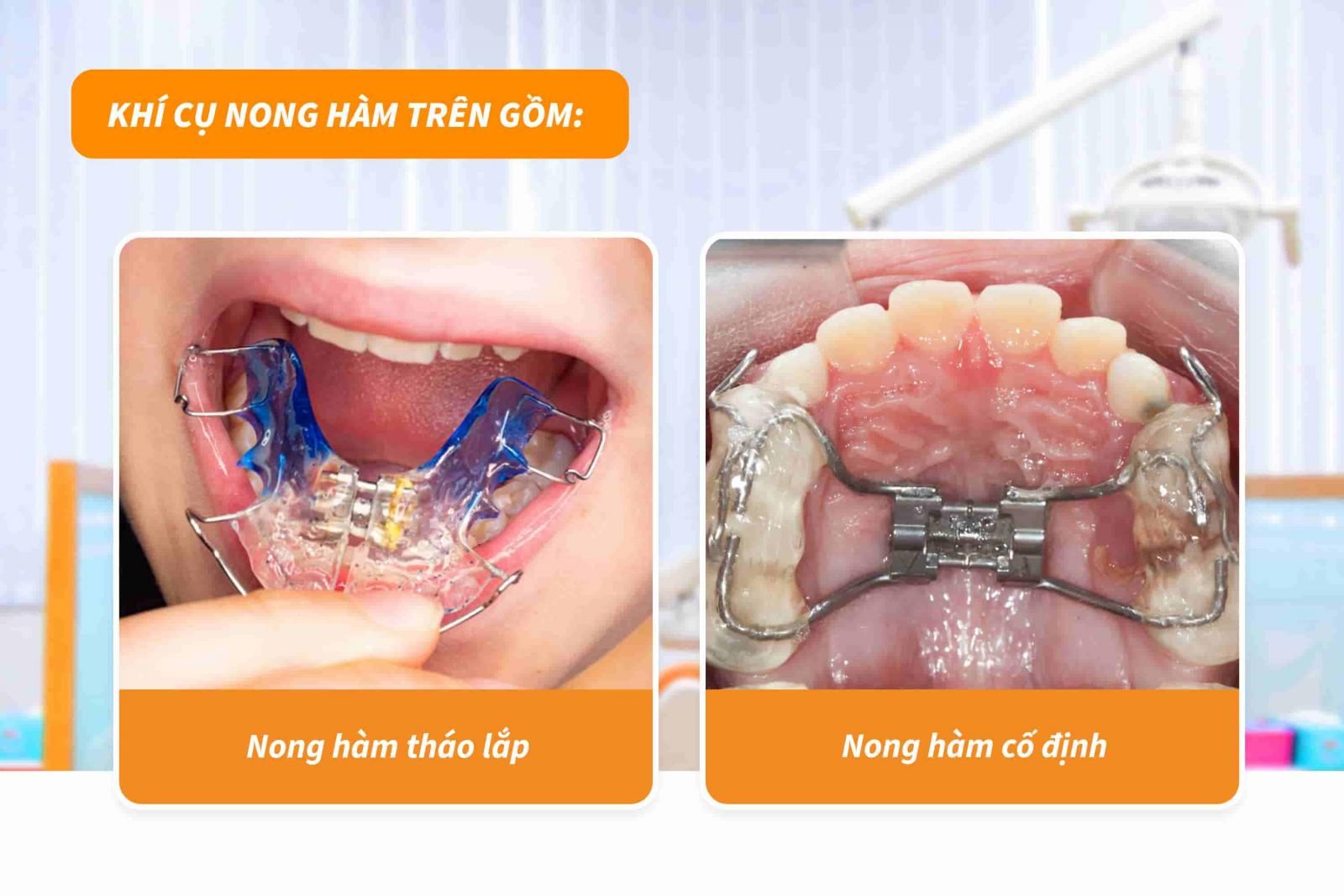 Các loại khí cụ nong hàm trên