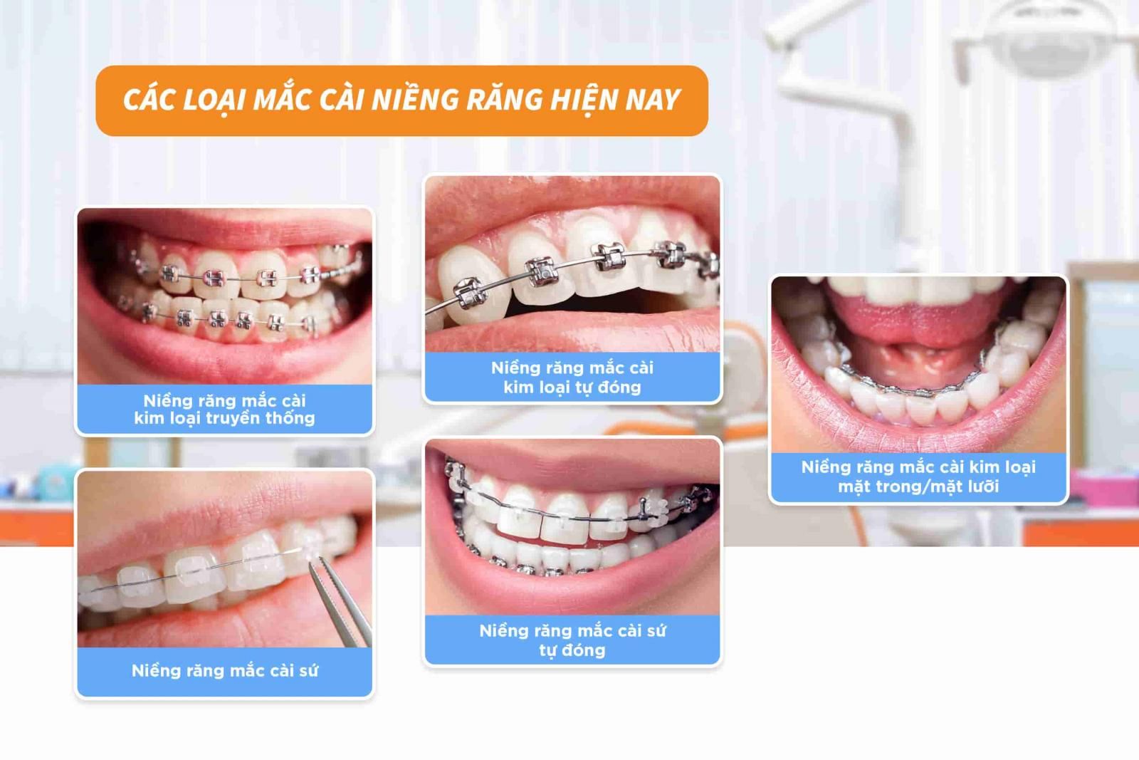 Các loại mắc cài niềng răng hiện nay