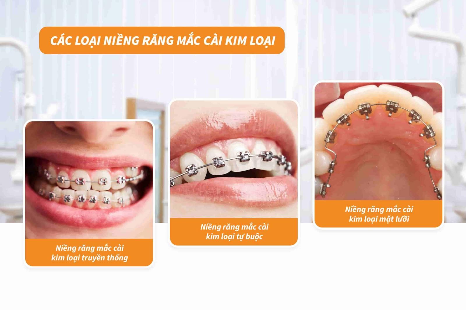 các loại niềng răng mắc cài kim loại