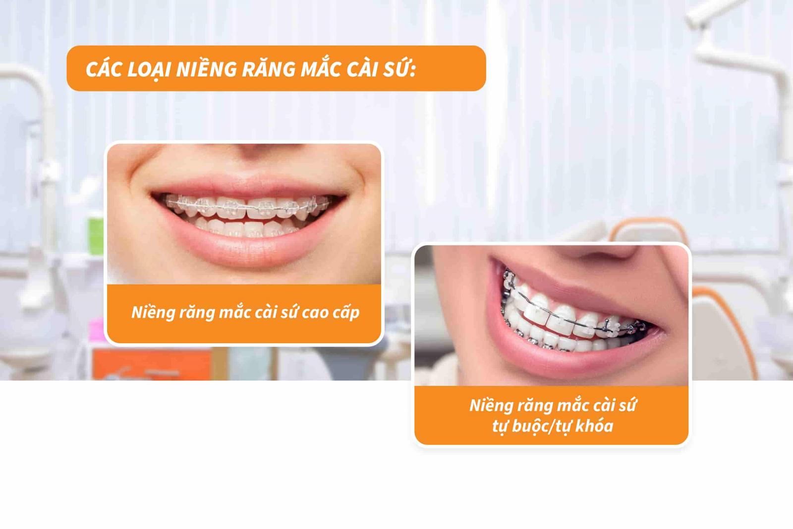 Các loại niềng răng mắc cài sứ hiện nay