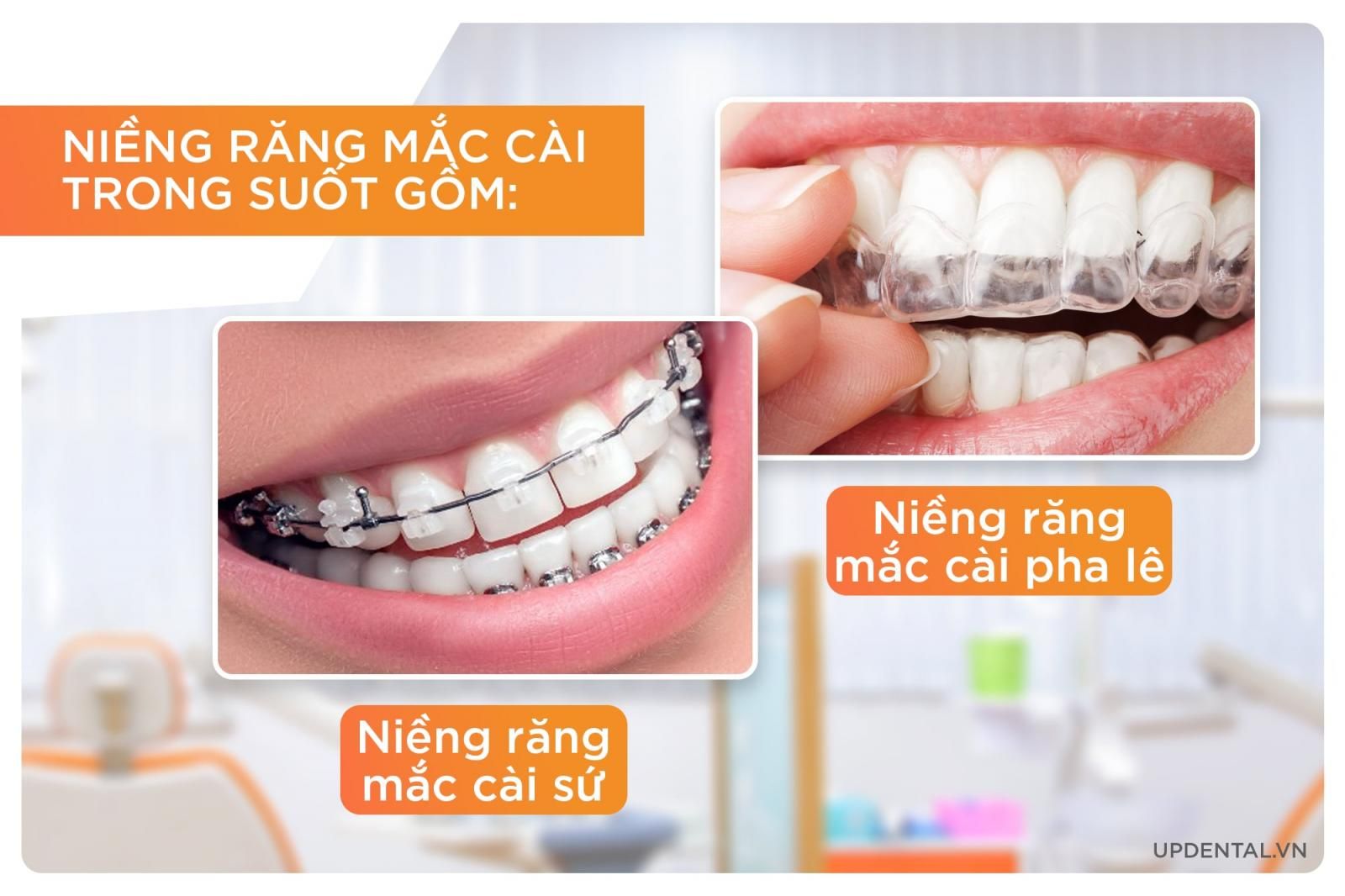 Niềng răng mắc cài trong suốt