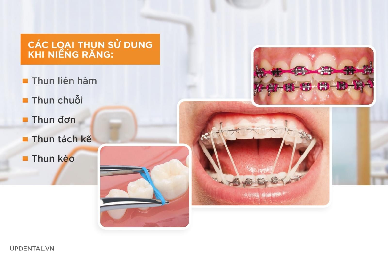 các loại thun sử dụng khi niềng răng