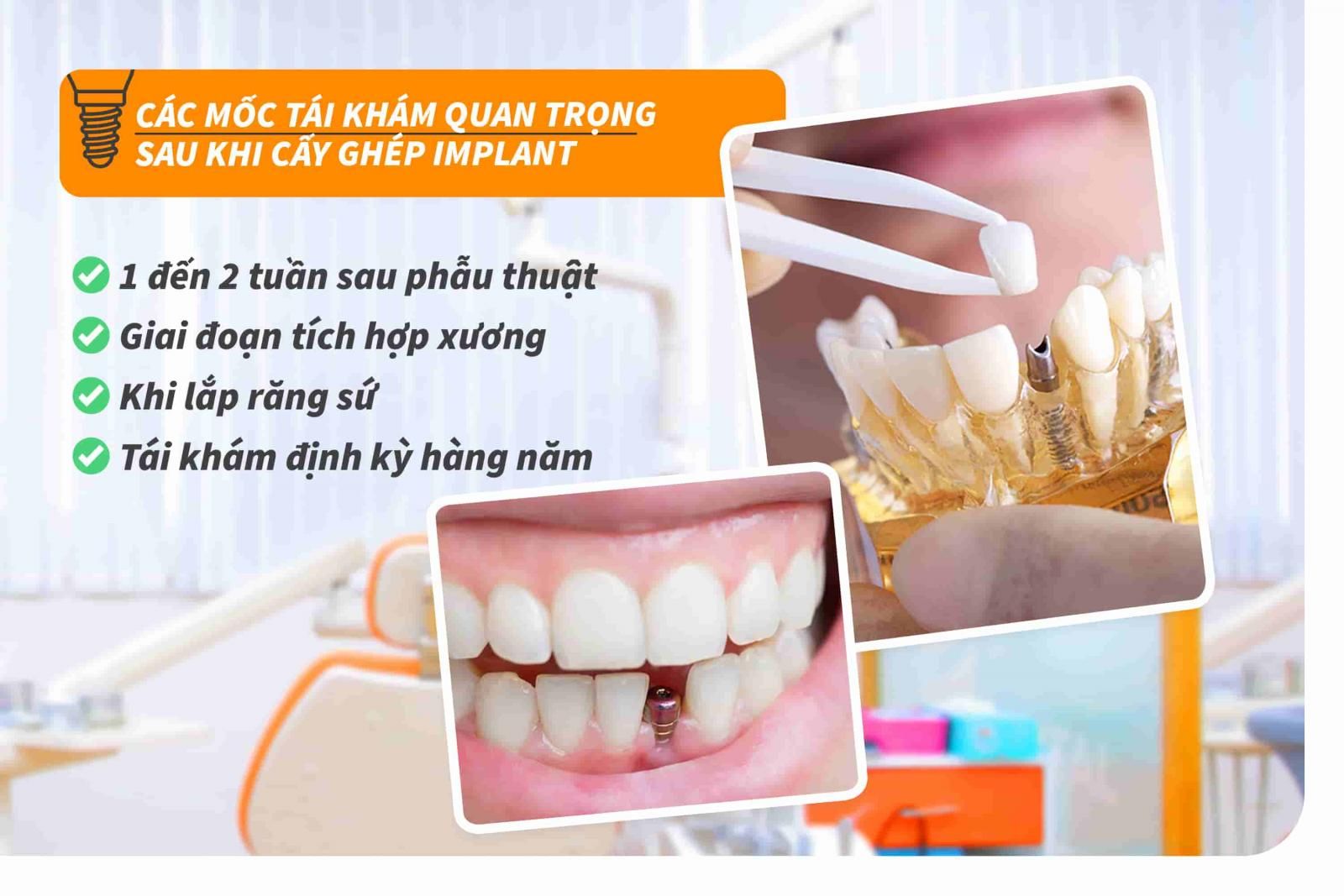 Các mốc tái khám quan trọng sau khi cấy ghép Implant