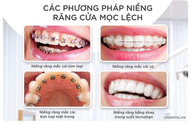 các phương pháp niềng răng cửa mọc lệch