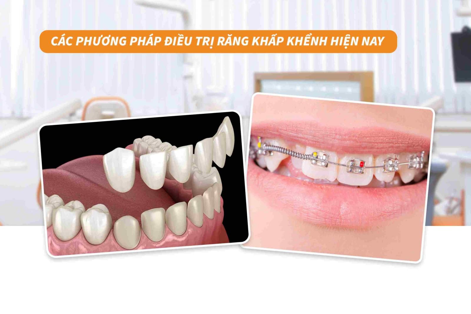 Các phương pháp điều trị răng khấp khểnh hiện nay