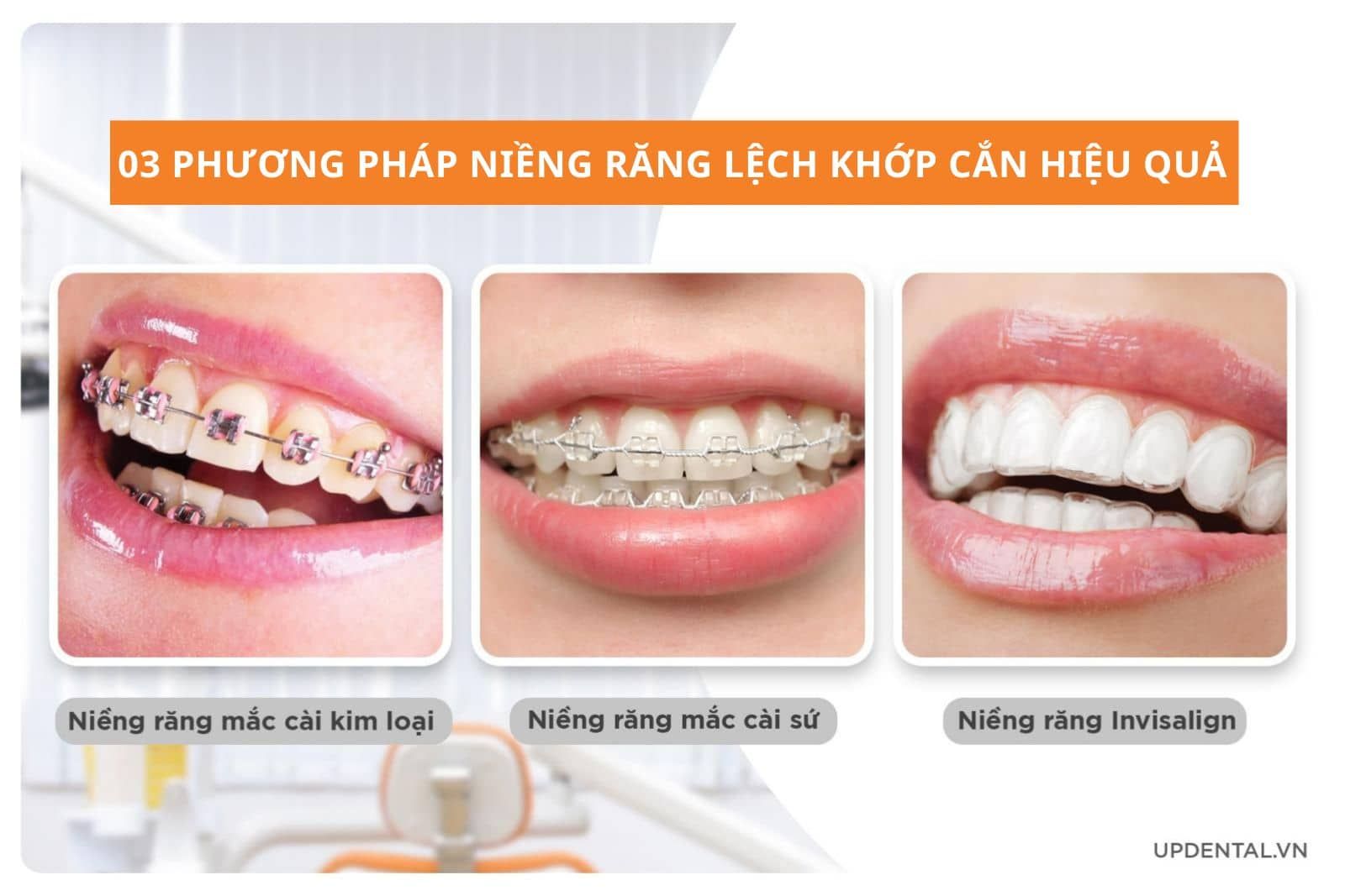 3 phương pháp niềng răng lệch khớp cắn hiệu quả