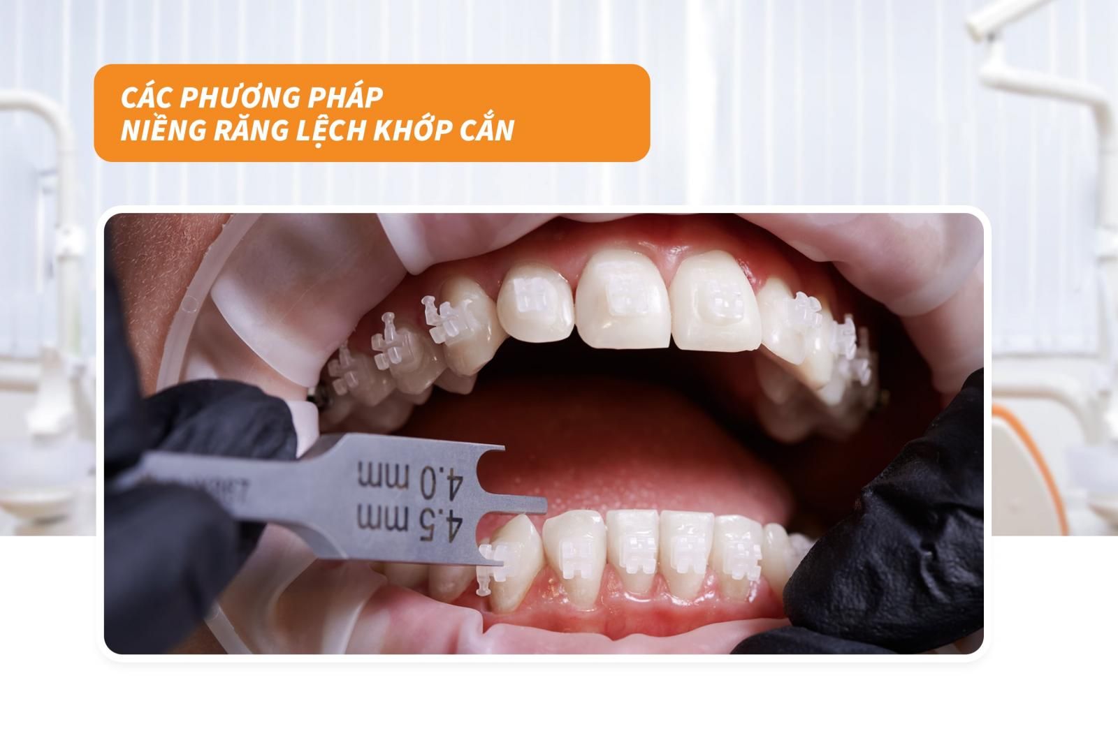 4 phương pháp niềng răng lệch khớp cắn