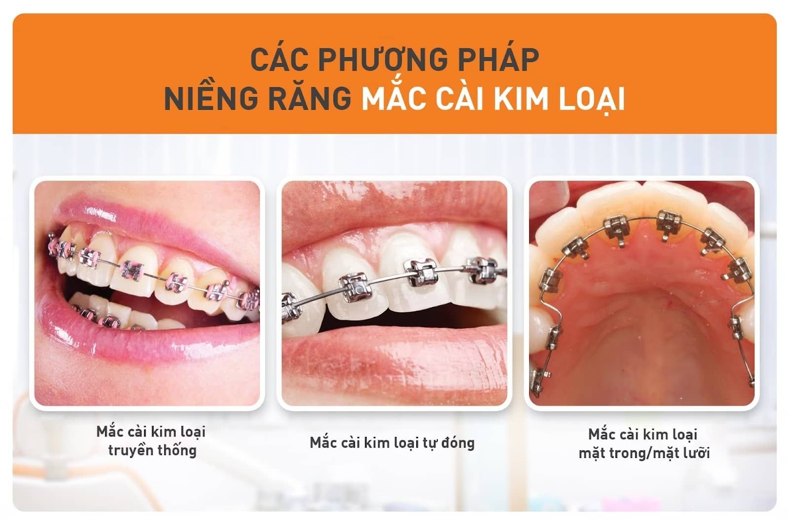 Niềng răng mắc cài kim loại