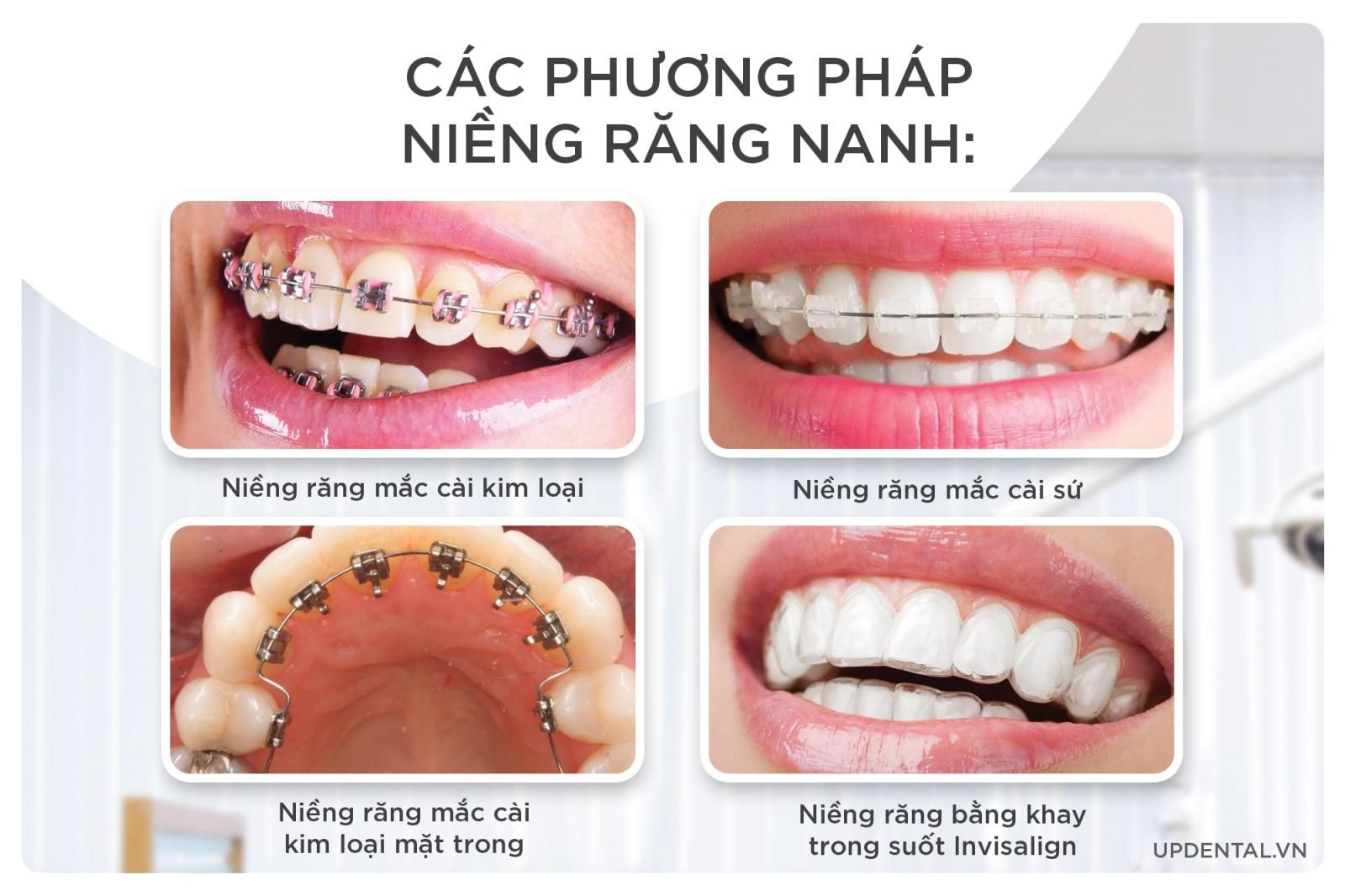 các phương pháp niềng răng nanh