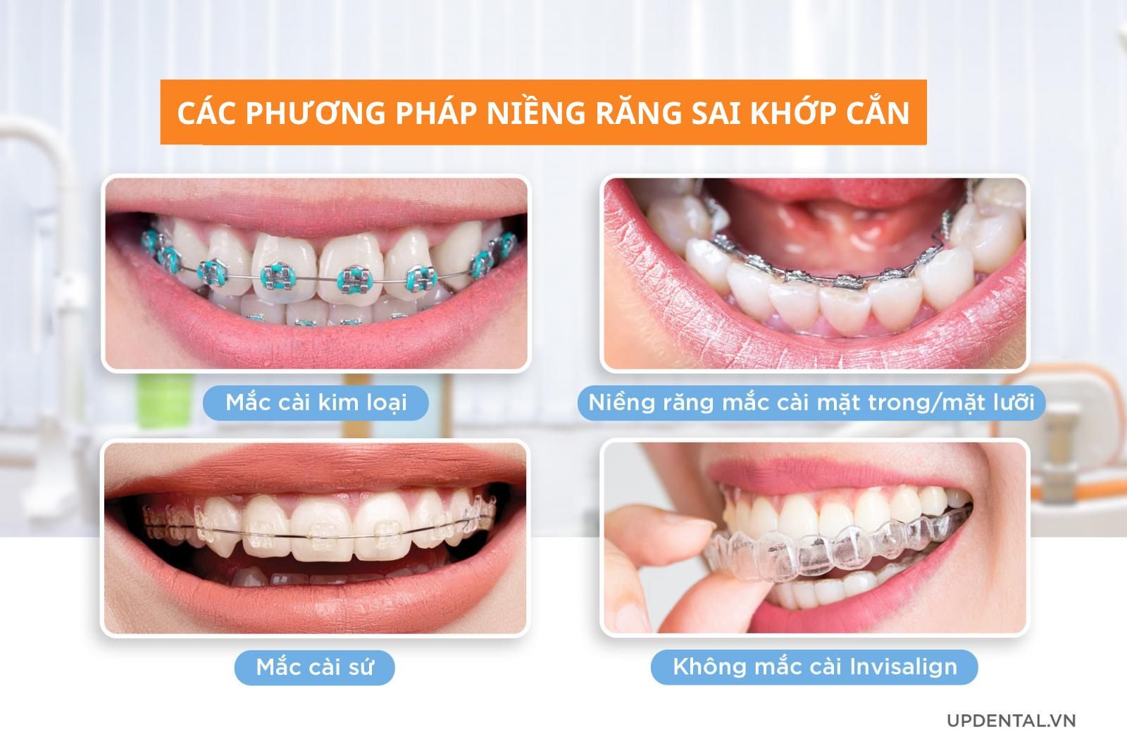 Các phương pháp niềng răng sai khớp cắn