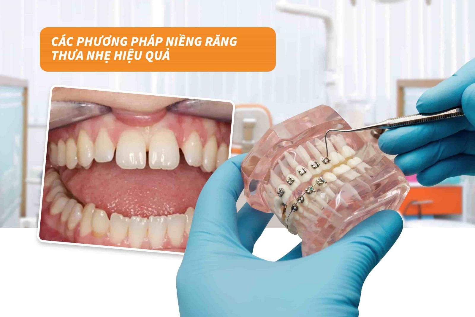 Các phương pháp niềng răng thưa nhẹ hiệu quả