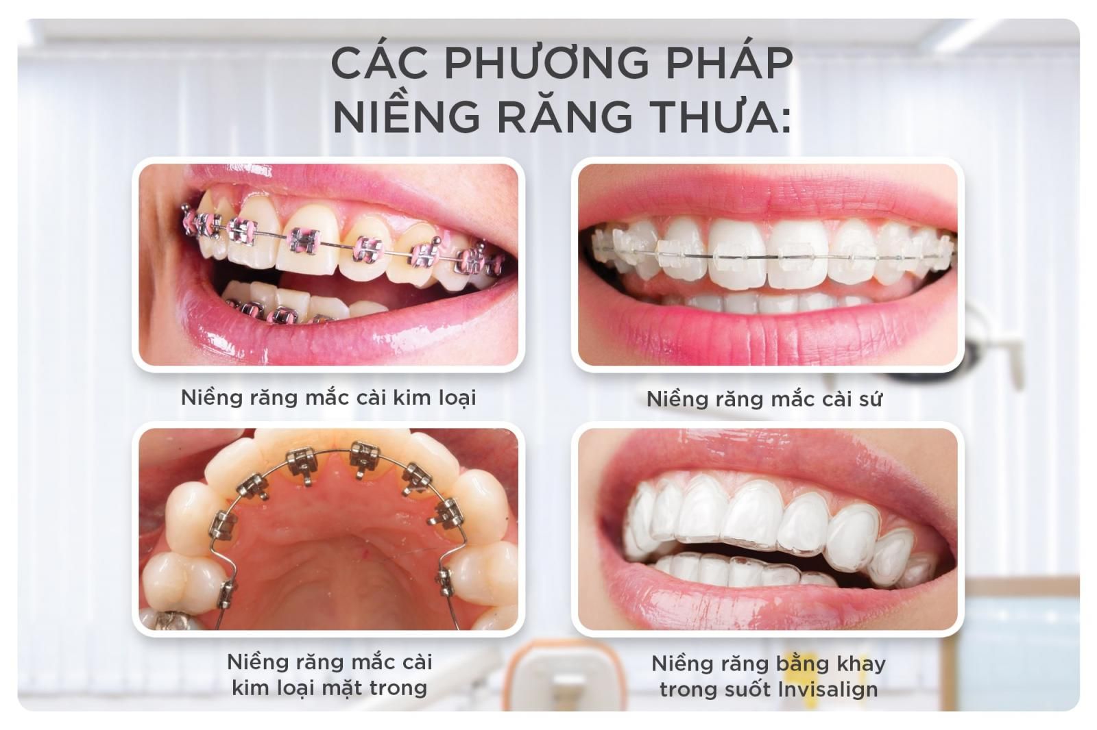 các phương pháp niềng răng thưa