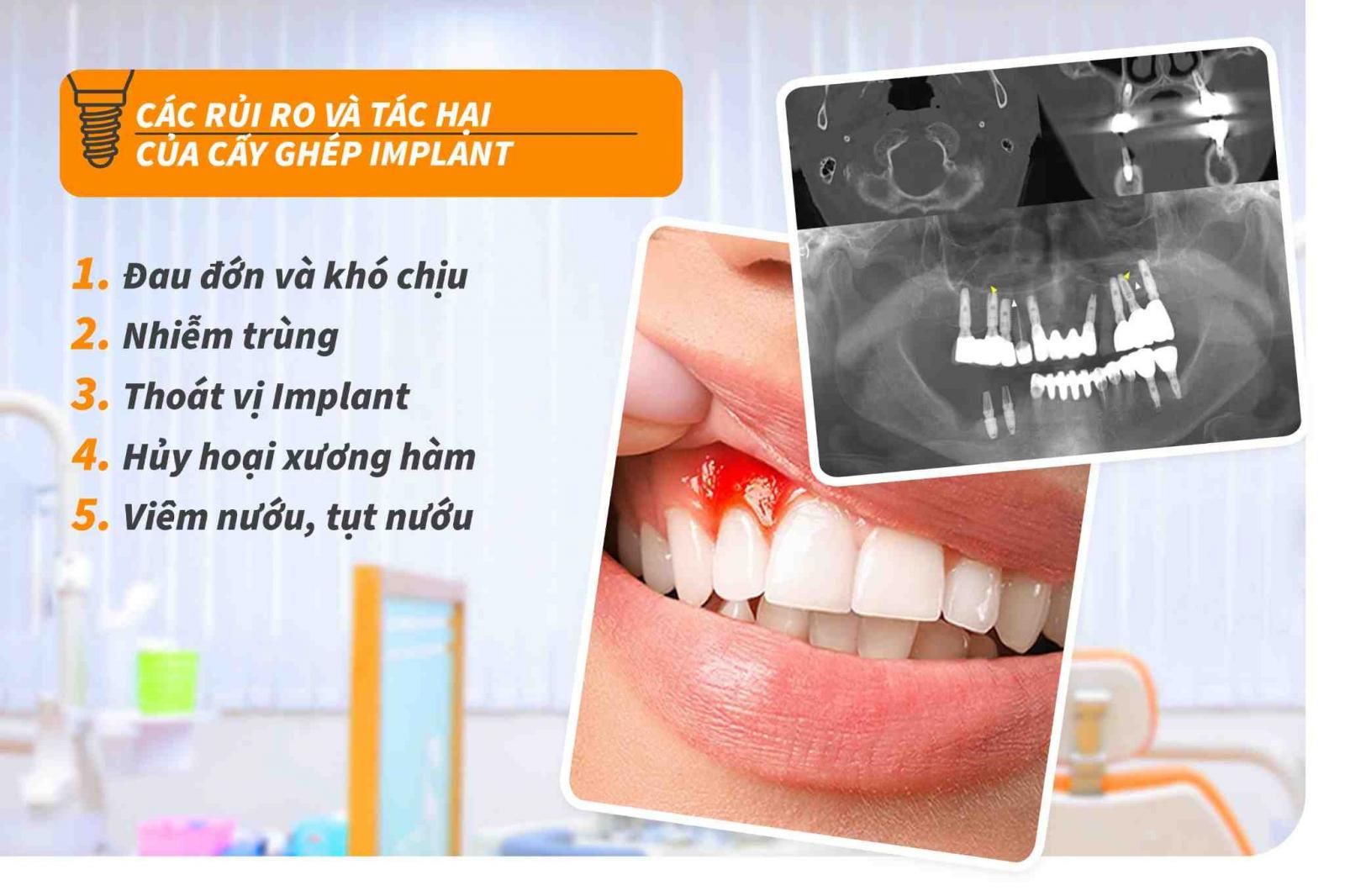 Các rủi ro và tác hại của cấy ghép Implant 