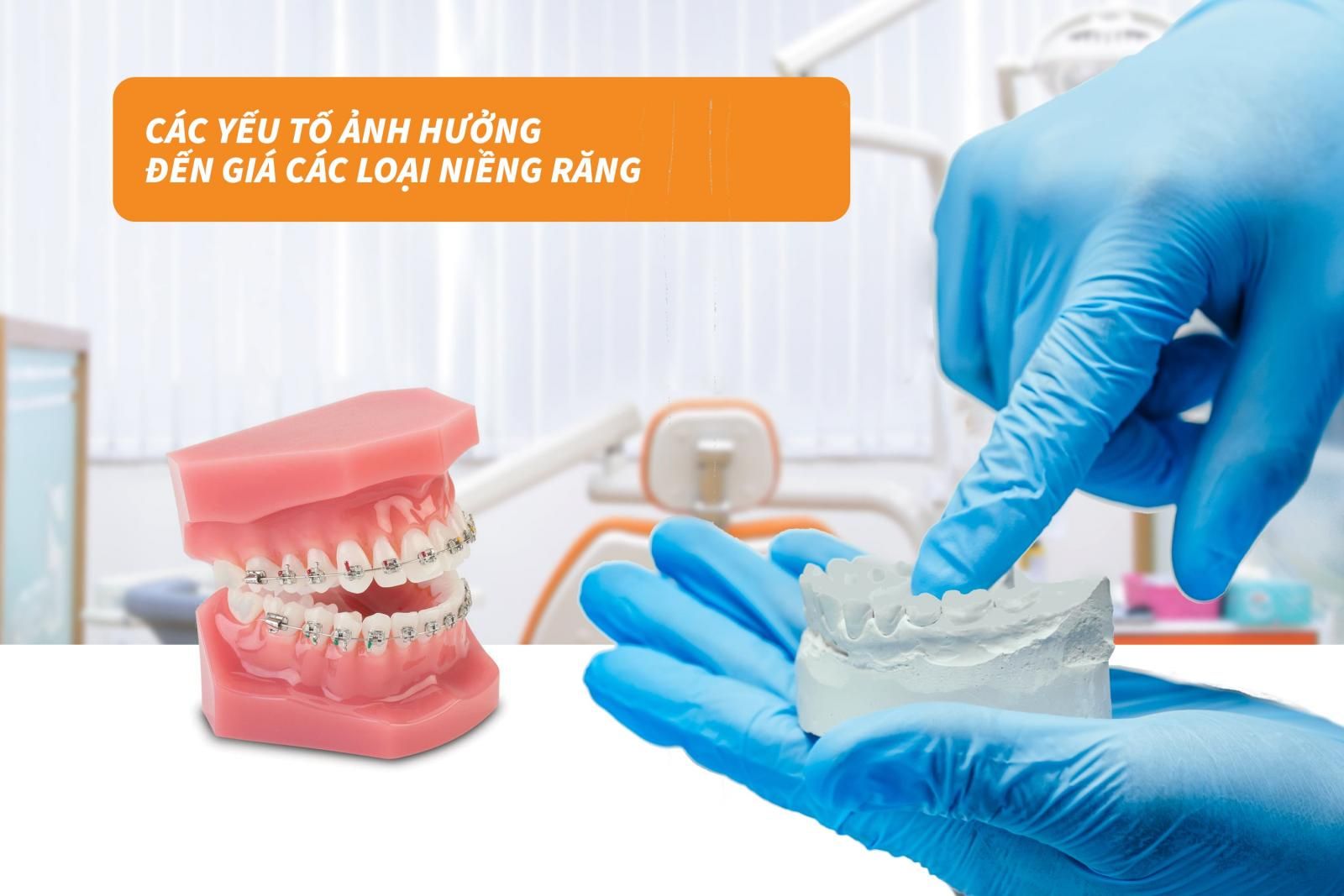 6 yếu tố ảnh hưởng đến giá các loại niềng răng