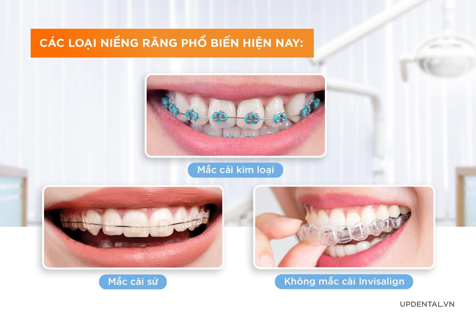 Các loại niềng răng phổ biến hiện nay