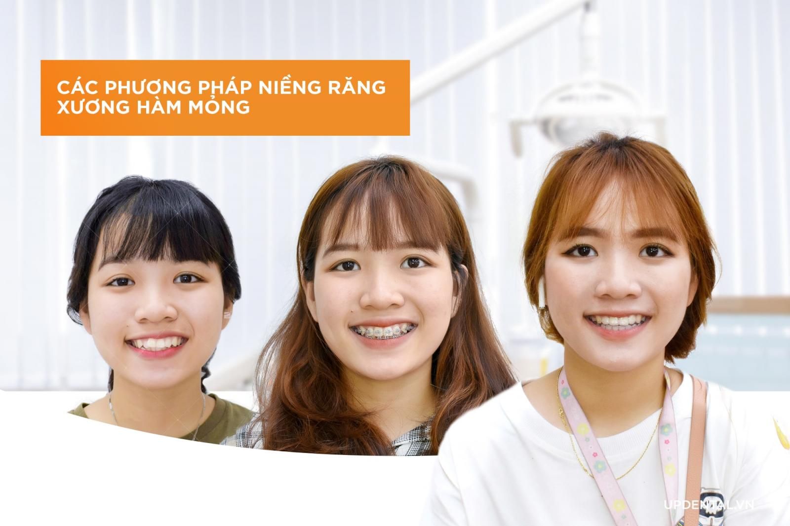 Các phương pháp niềng răng hàm mỏng