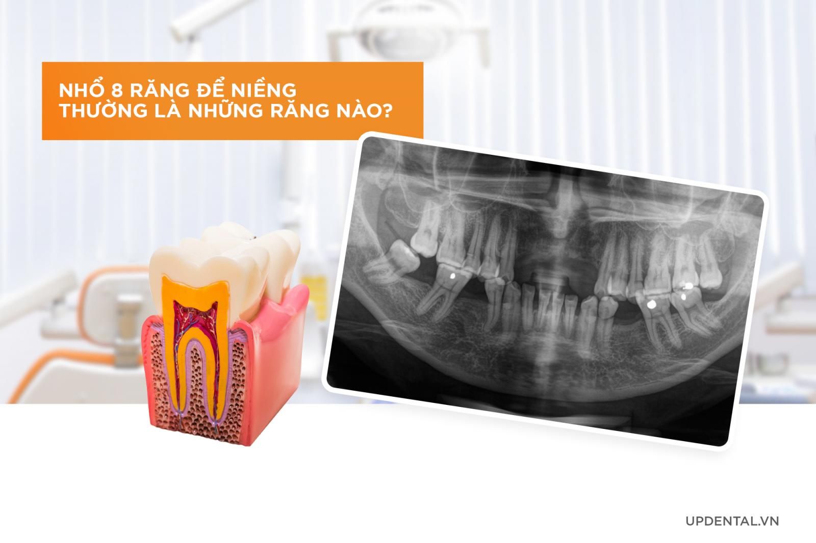 Nhổ 8 răng để niềng thường là những răng nào?