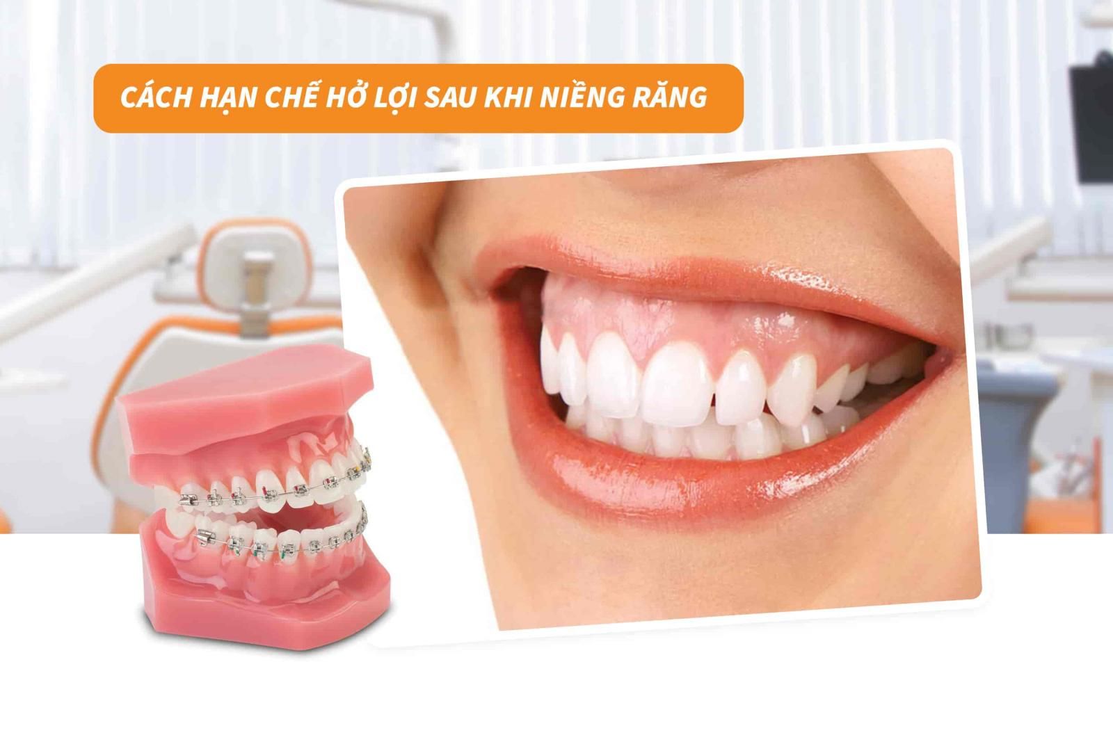 Cách hạn chế hở lợi sau khi niềng răng 