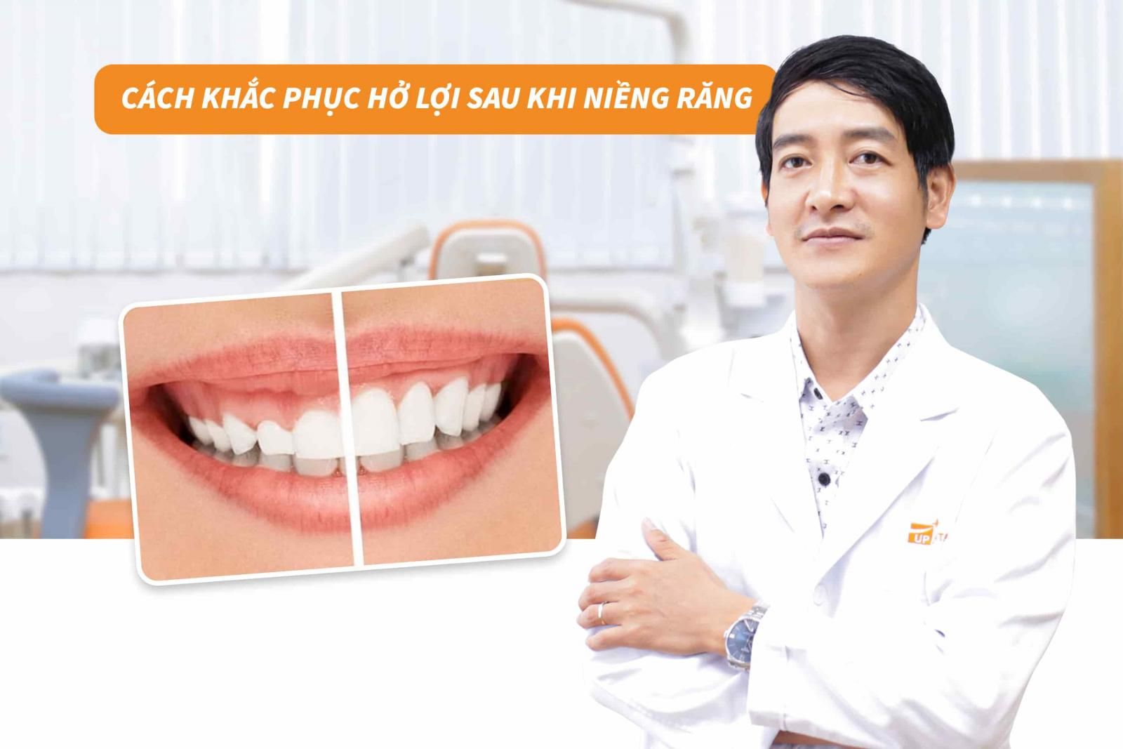 Cách khắc phục hở lợi sau khi niềng răng 