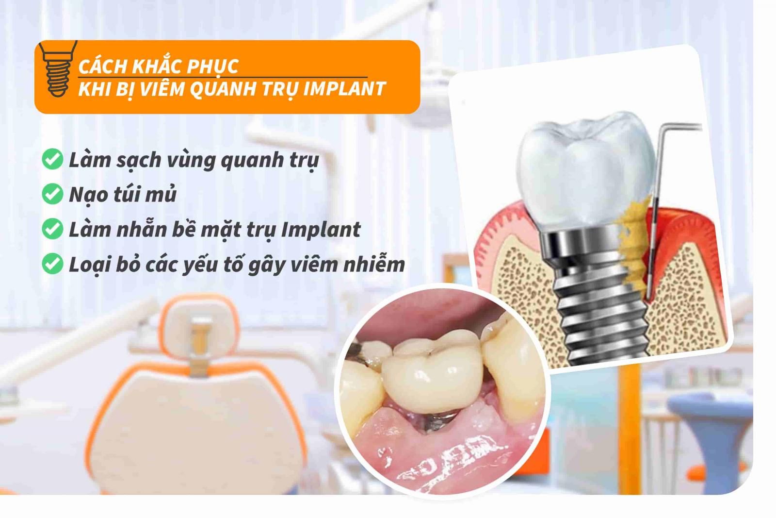 Các khắc phục khi bị viêm quanh trụ Implant