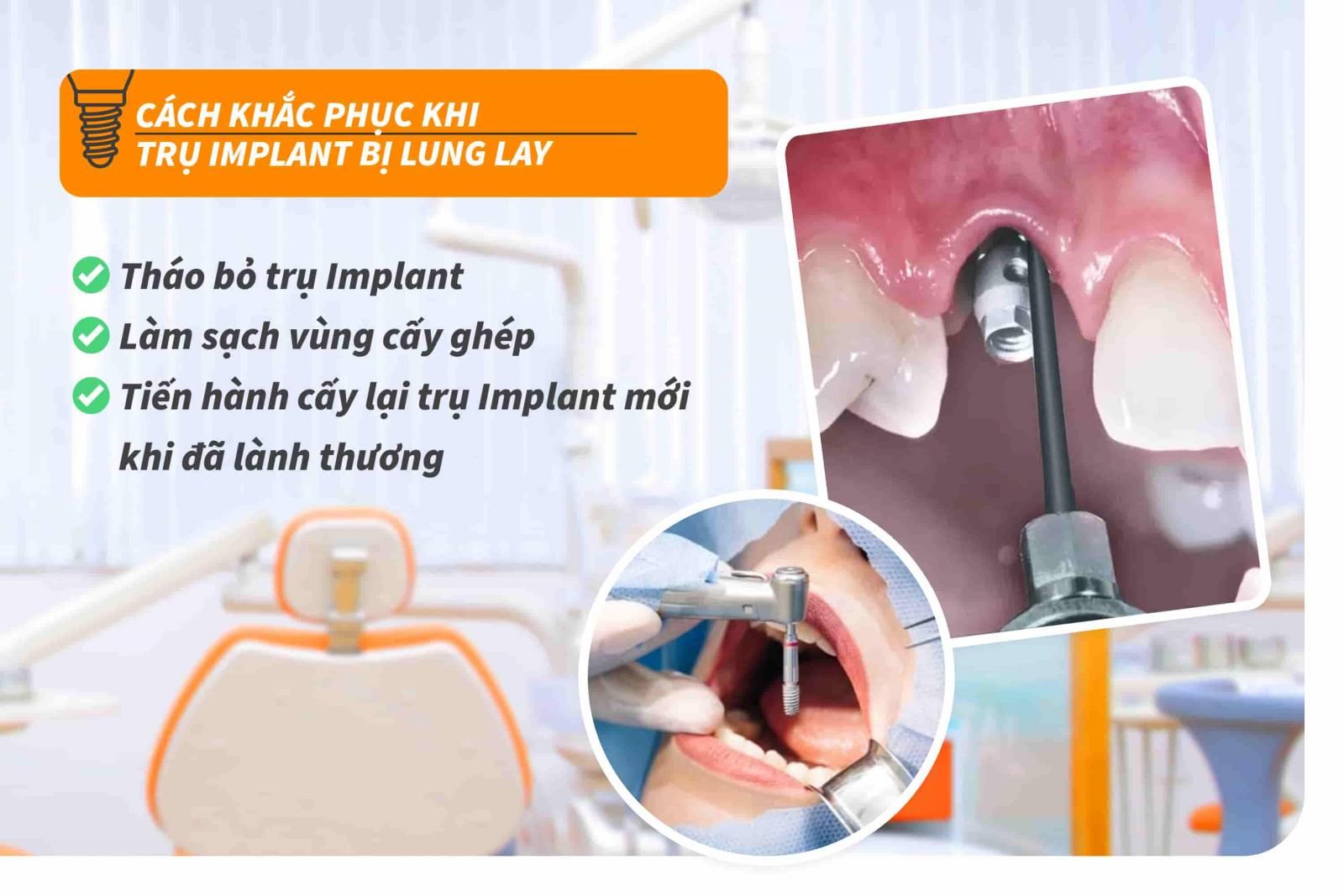 Cách khắc phục khi trụ Implant bị lung lay