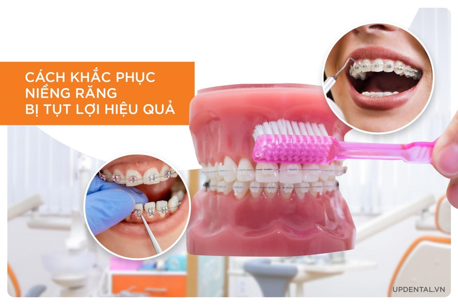 cách khắc phục niềng răng bị tụt lợi