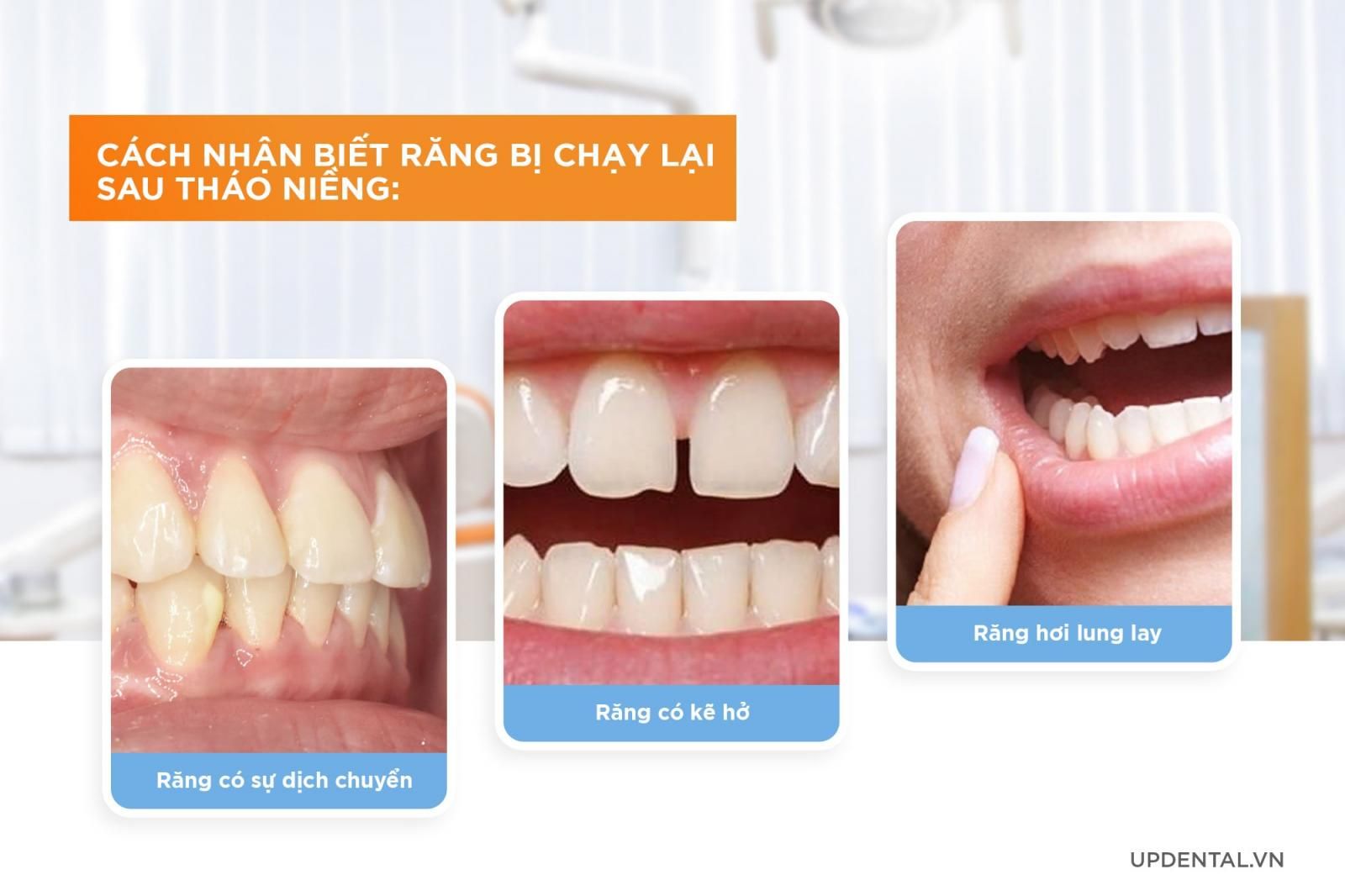 cách nhận biết răng bị chạy lại sau tháo niềng