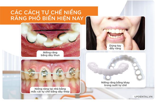 các cách tự chế niềng răng