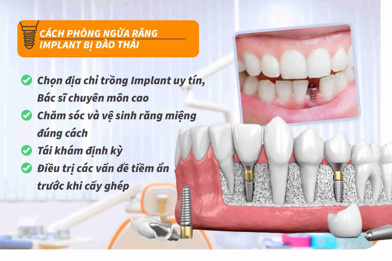 Cách phòng ngừa răng Implant bị đào thải