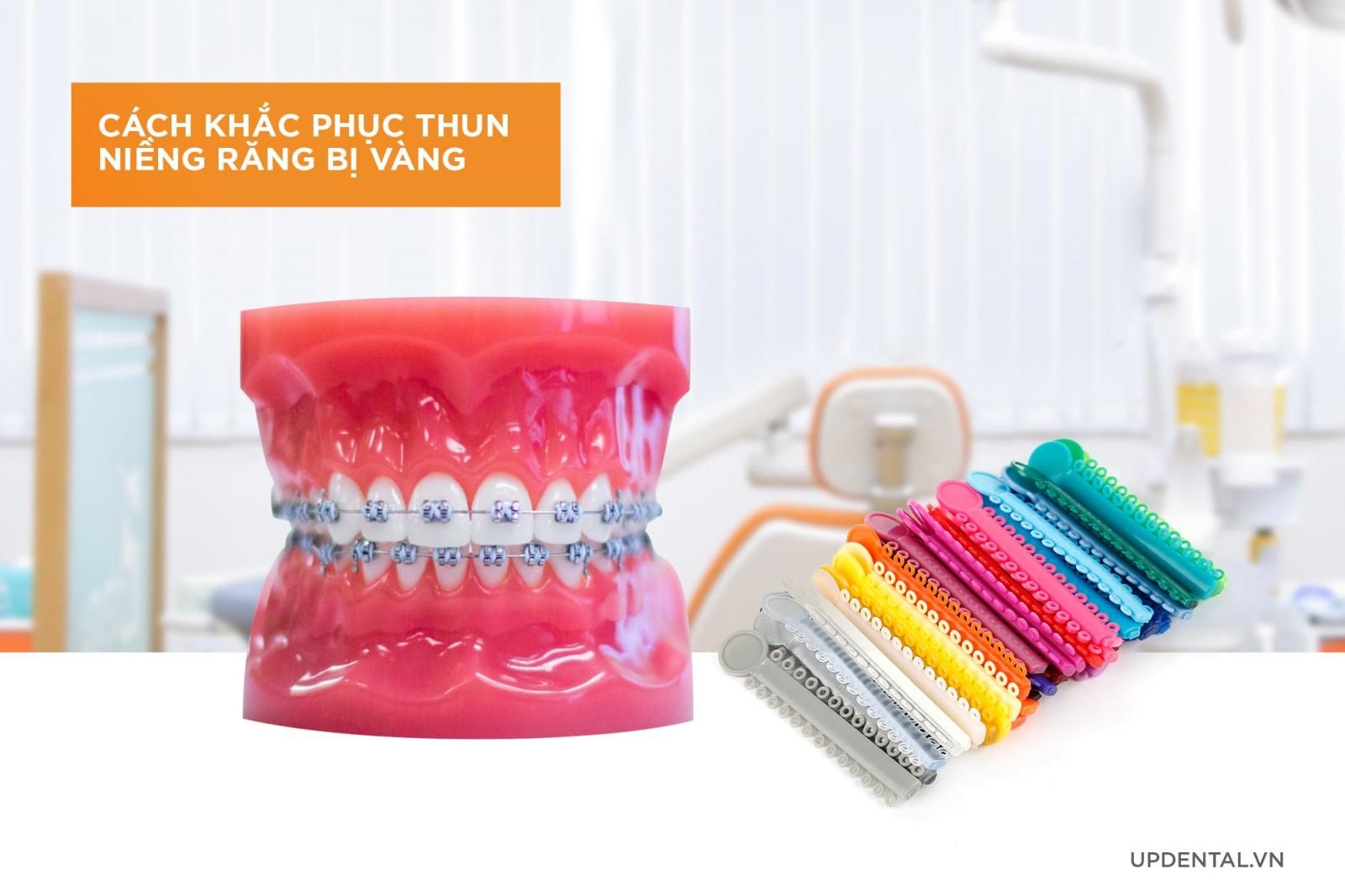 Cách khắc phục thun niềng răng bị vàng